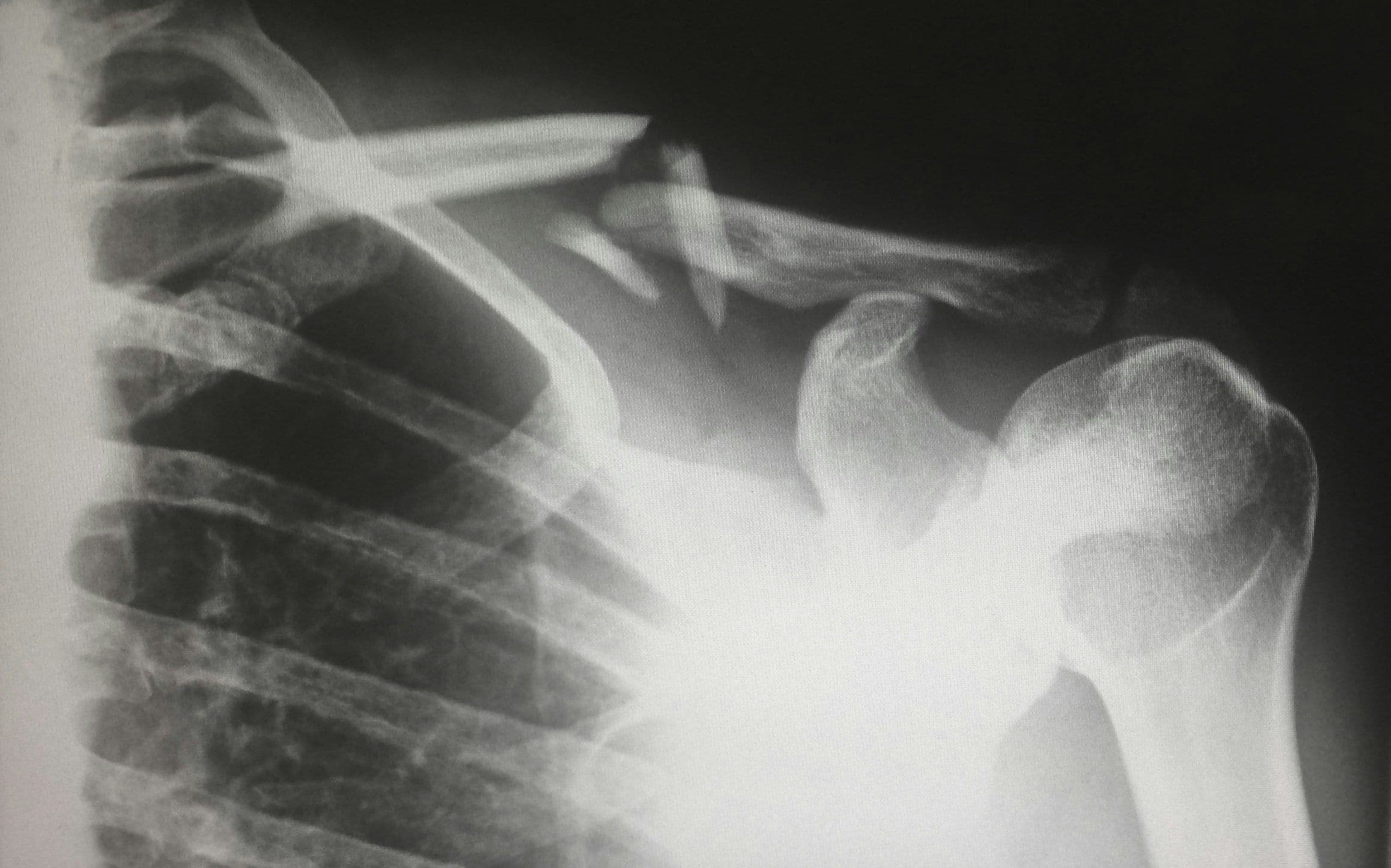 Catastrophic Injury