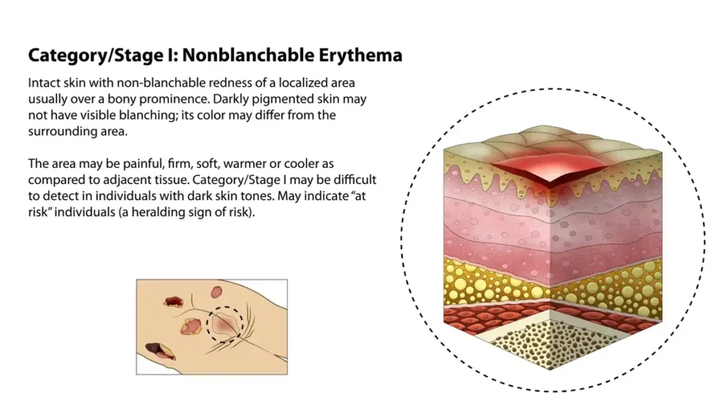 Category/Sage 1: Nonblanchable Erythema